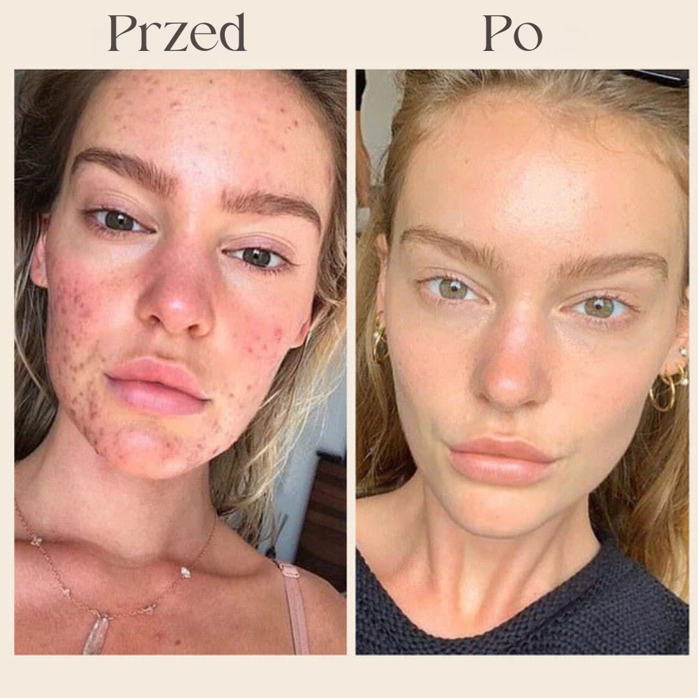 Przed_Po_1_MASKA_KOLAGENOWA.jpg