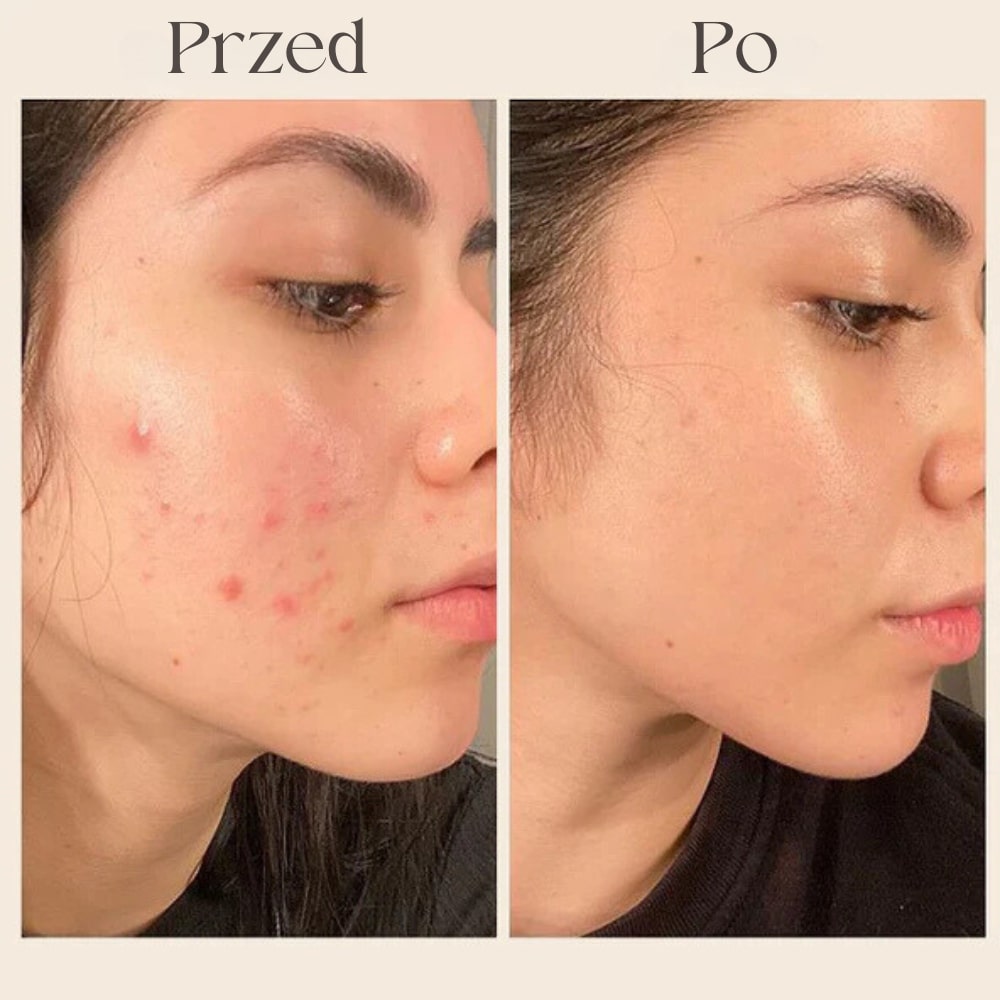 Przed_Po_2_MASKA_KOLAGENOWA.jpg