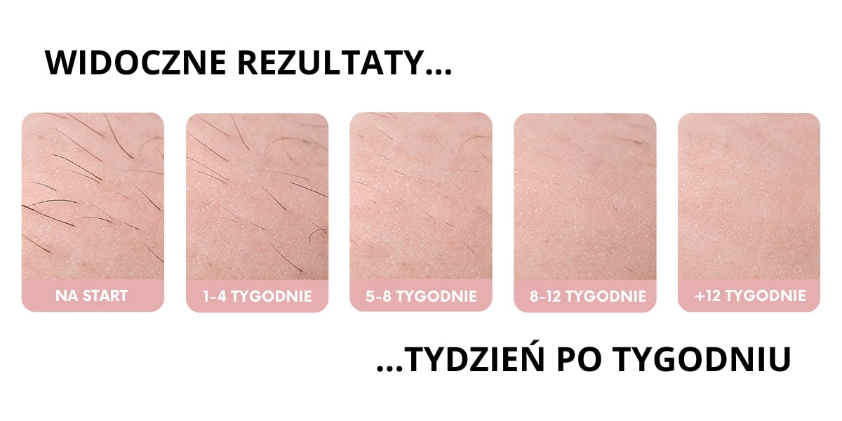 Efekty regularnej depilacji IPL tydzień po tygodniu